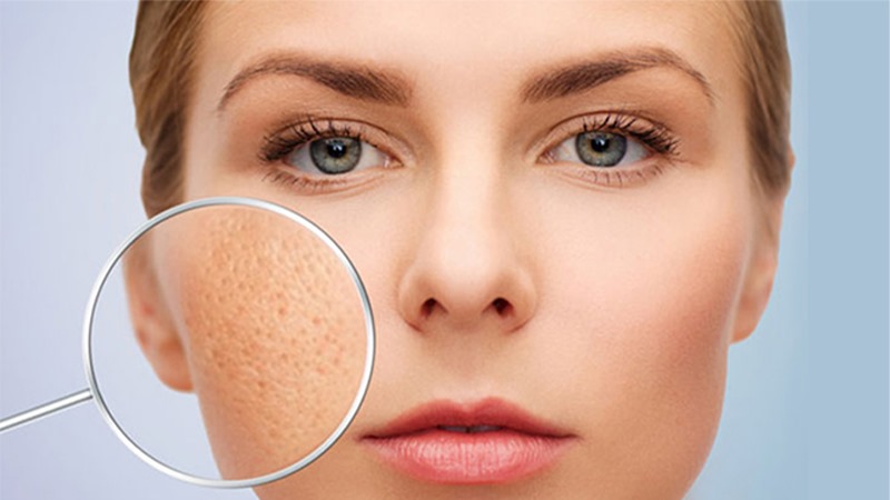 cách chăm sóc da mặt bị rỗ