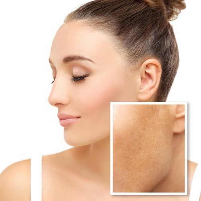 Nguyên nhân, cách chăm sóc da mặt không đều màu