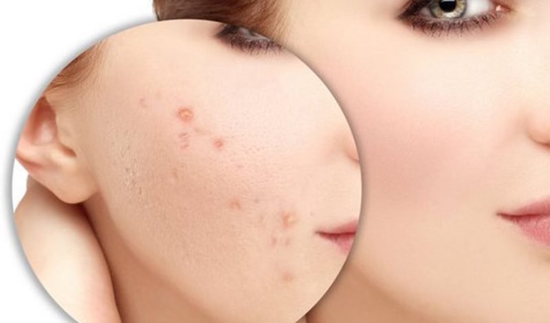 cách chăm sóc da mặt sau mụn