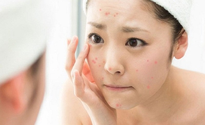 Các vấn đề,cách chăm sóc da mặt sau mụn về da thường gặp