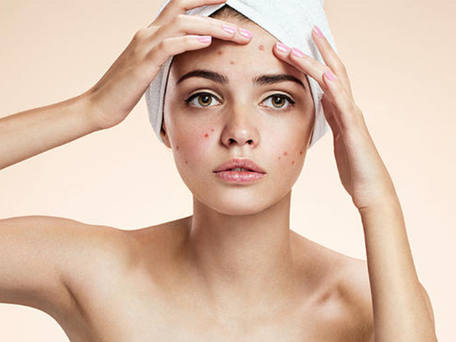 Những lưu ý cách chăm sóc da mặt sau mụn