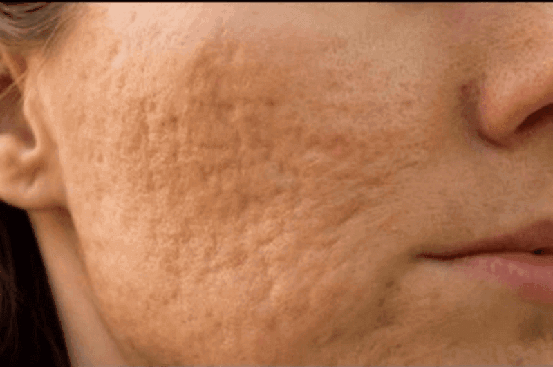 Làm thế nào để cách trị da mặt sần vỏ cam