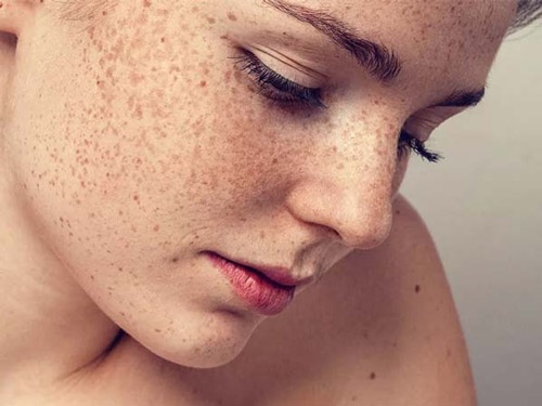 Làn da tuổi tác, cách trị đồi mồi da mặt là gì?