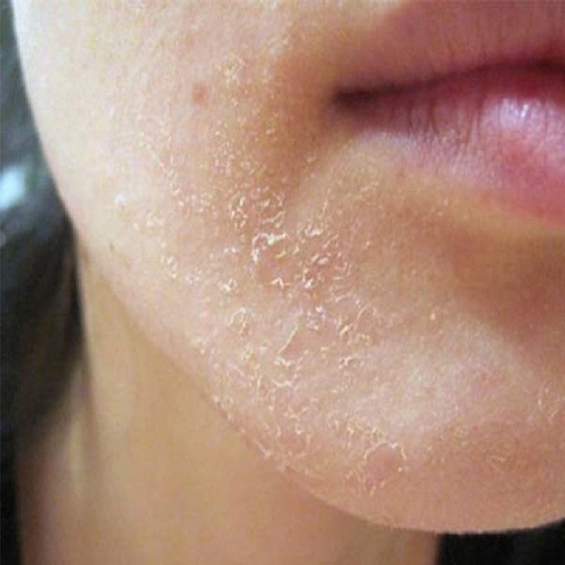 cách chăm sóc da mặt vào mùa hanh khô