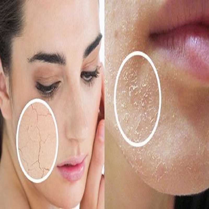 Tại sao da khô và nứt nẻ, cách chăm sóc da mặt vào mùa hanh khô?