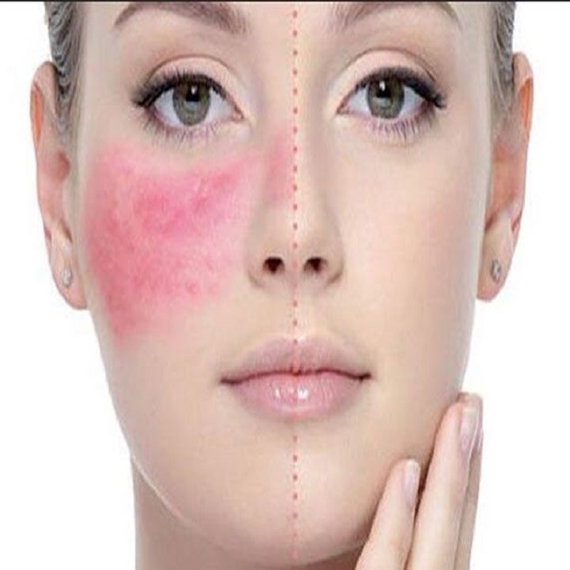 Tìm hiểu về dị ứng da mặt, cách chữa bị dị ứng da mặt