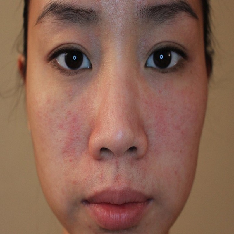 Dấu hiệu nhận biết, cách chữa bị dị ứng da mặt