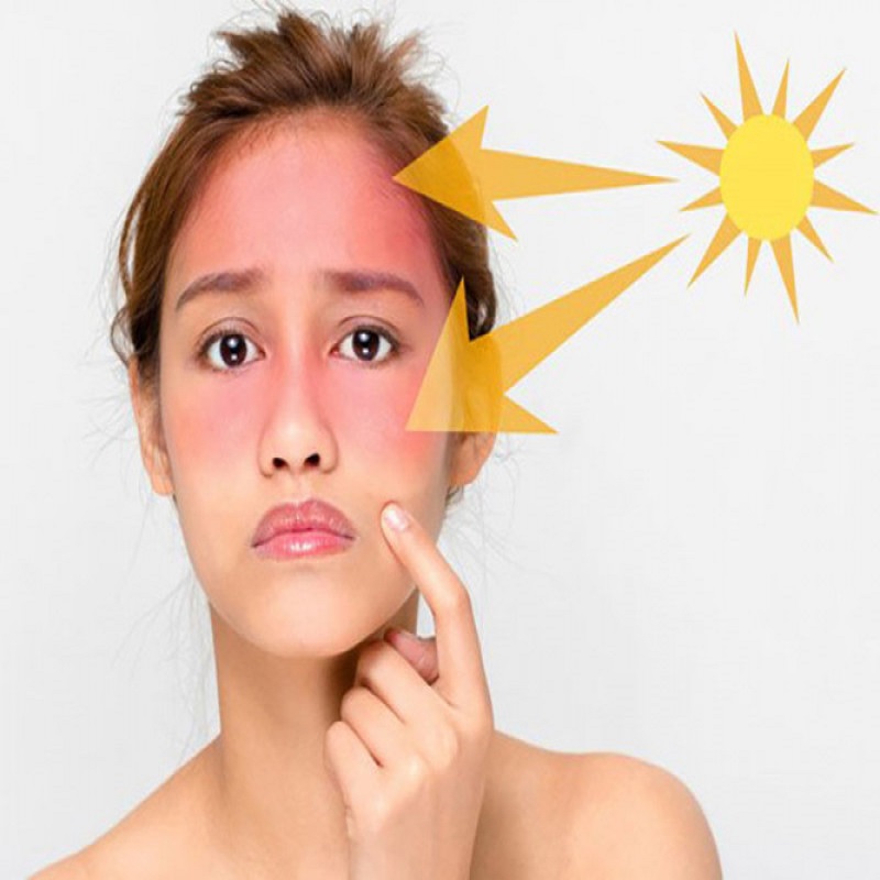 10 cách chữa cháy da mặt từ thiên nhiên