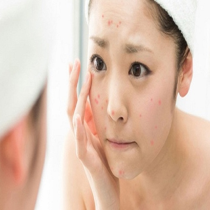 Hậu quả nặng nề của việc chăm sóc da không đúng cách làm sạch da mặt ở tuổi dậy thì