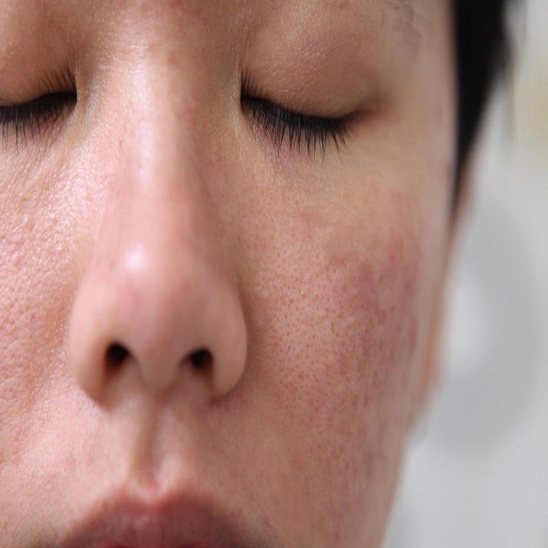 Da mặt sần sùi, cách trị da mặt bị sần là gì?